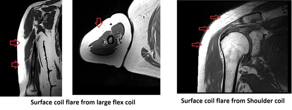 The surface coil flare artifact flex coil