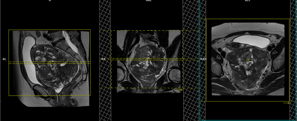 Uterine fibroids MRI protocol and planning of axial epi DWI scans