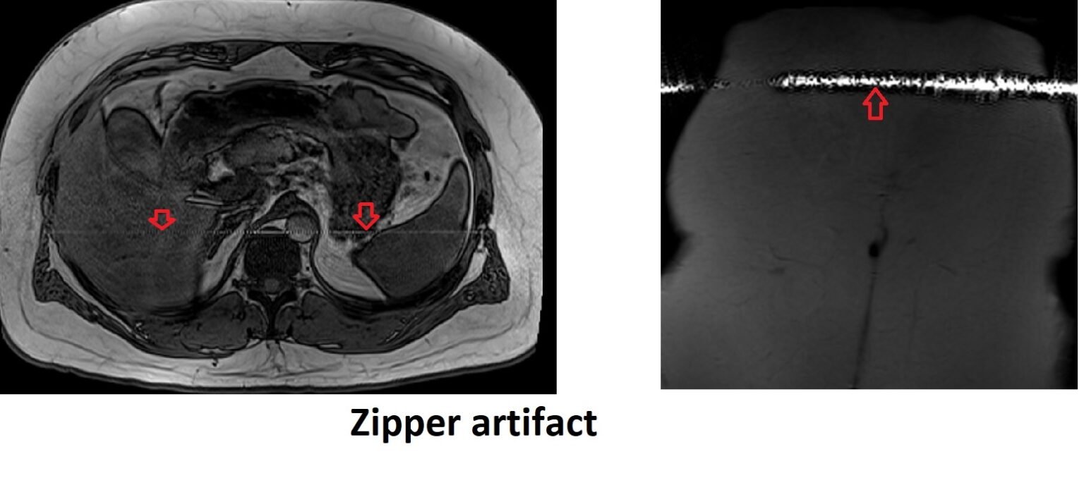 Zipper Artifact MRI RF Leak Artifact MRI