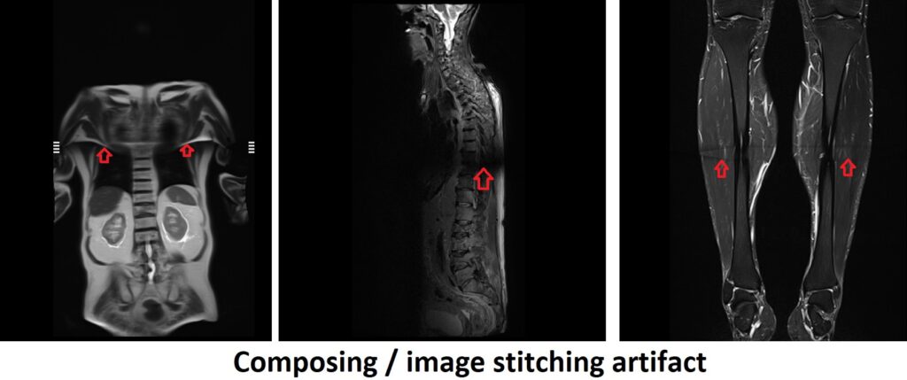 composing or image stitching artifact MRI