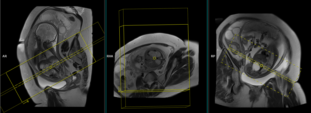 fetal abdomen MRI planning and protocol of axial scan