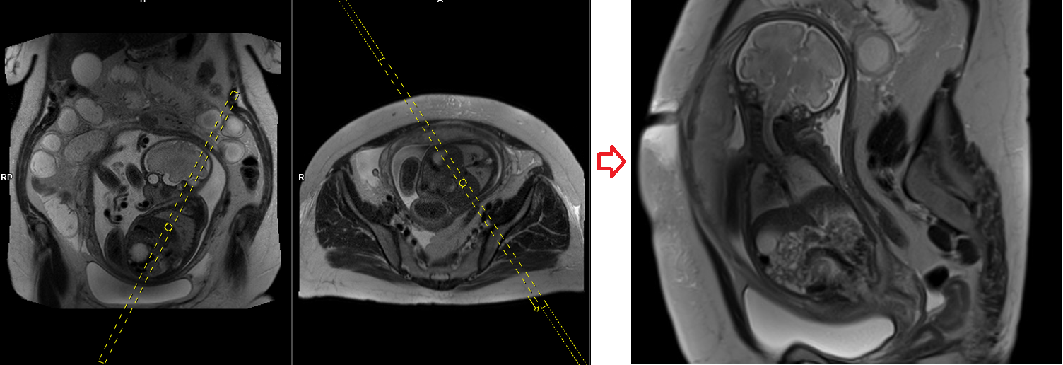 Fetal Abdominal Mri Fetal Abdominal Mri Protocol And Planning