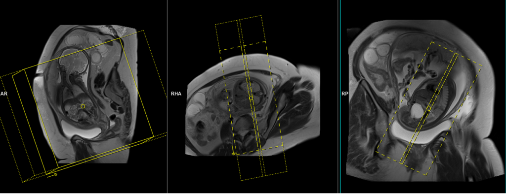 fetal abdomen MRI planning and protocol of coronal scan
