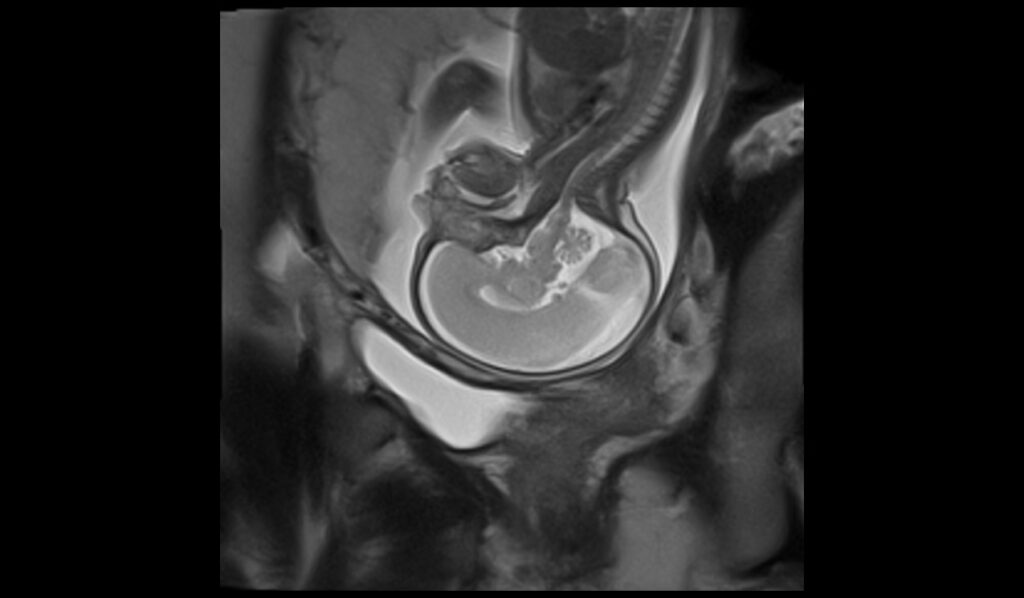 fetal brain mri sagittal localiser images - mrimaster