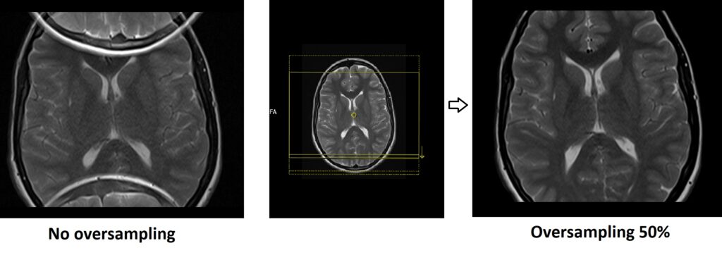 MRI oversampling, Fold-over suppression