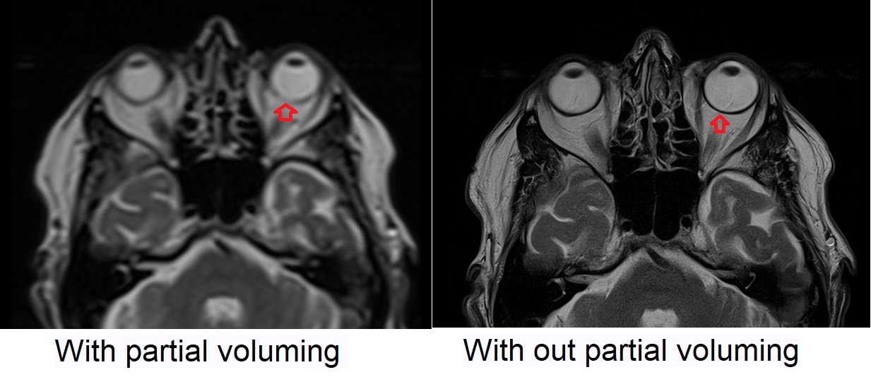 Partial voluming mri | Partial voluming artifact MRI