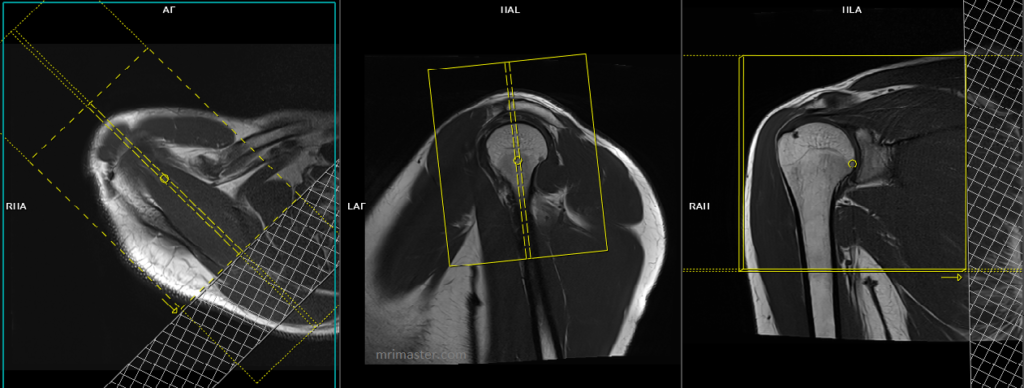 Shoulder MRI planning | MRI shoulder protocols | Indications for