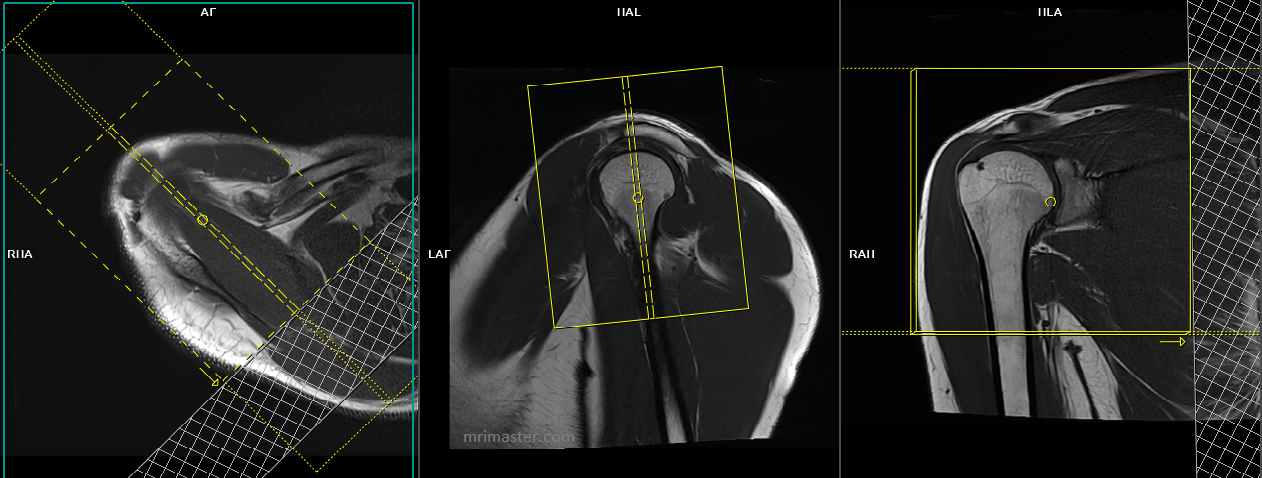 Shoulder MRI planning | MRI shoulder protocols | Indications for MRI ...