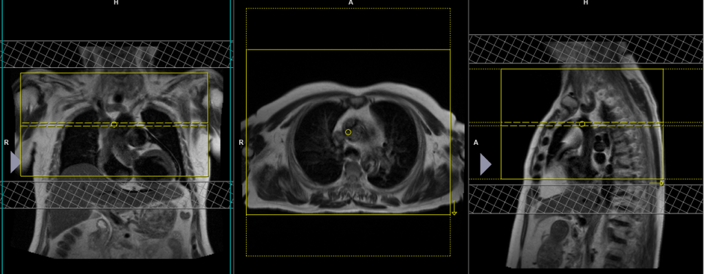 thymus MRI protocol and planning of axial large FOV scan