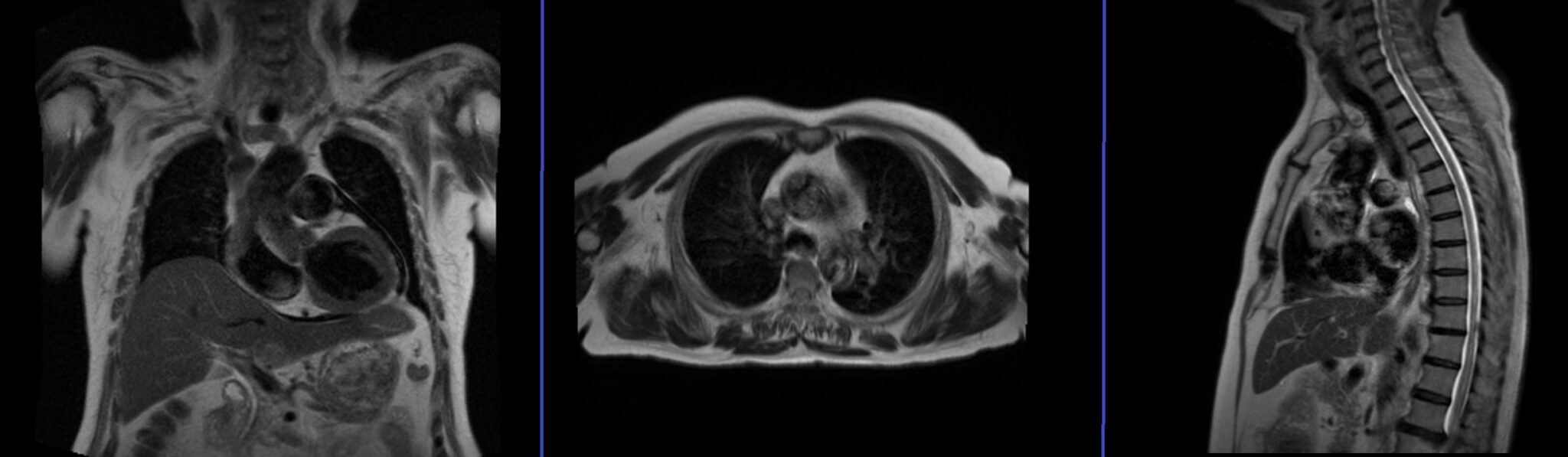 Thymus Mri Thymic Cyst Mri Protocol And Planning Thymoma Mri