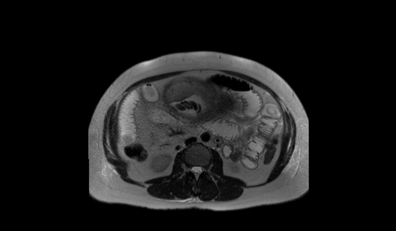 fetal abdomen mri axial large fov images