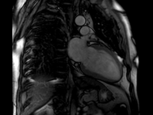 2 Chamber Image - MRI Planning