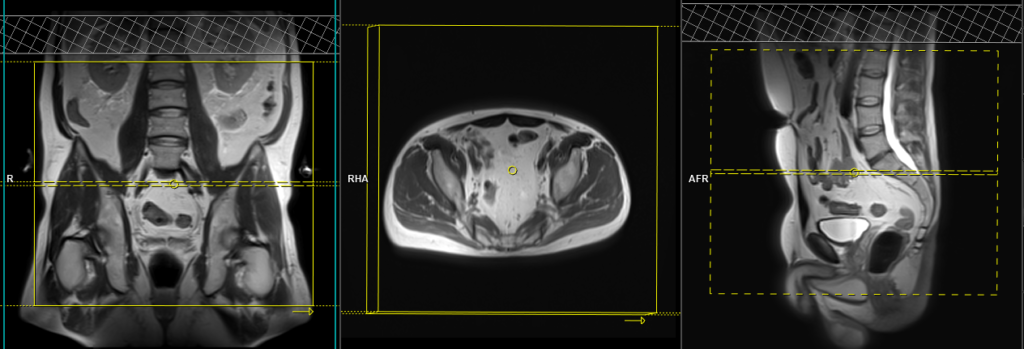 3T MRI prostate protocol and planning of axial large FOV scans