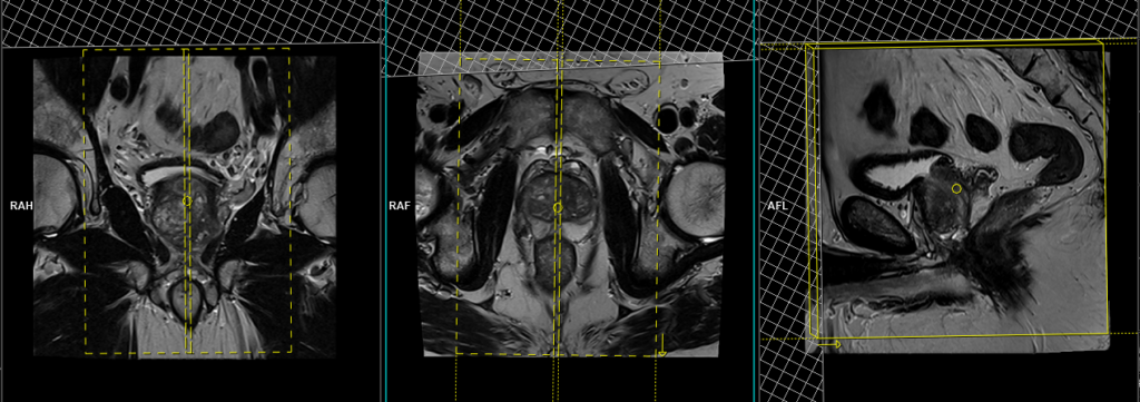 Mri Prostate Protocols Mri Prostate Cancer Multiparametric Planning