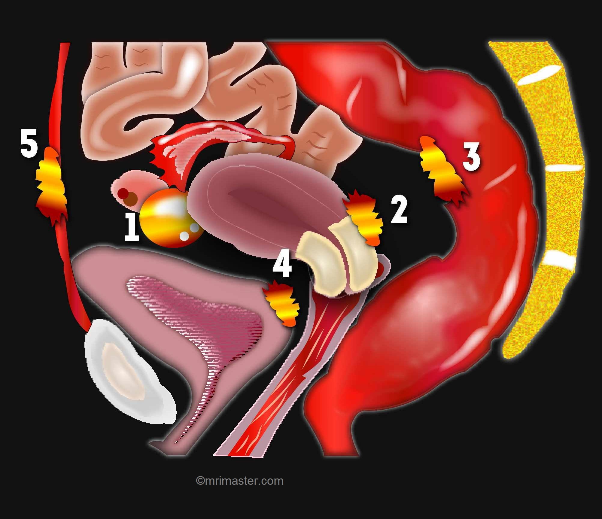 Endometriosis Mri Endometriosis Mri Protocol And Planning 4259