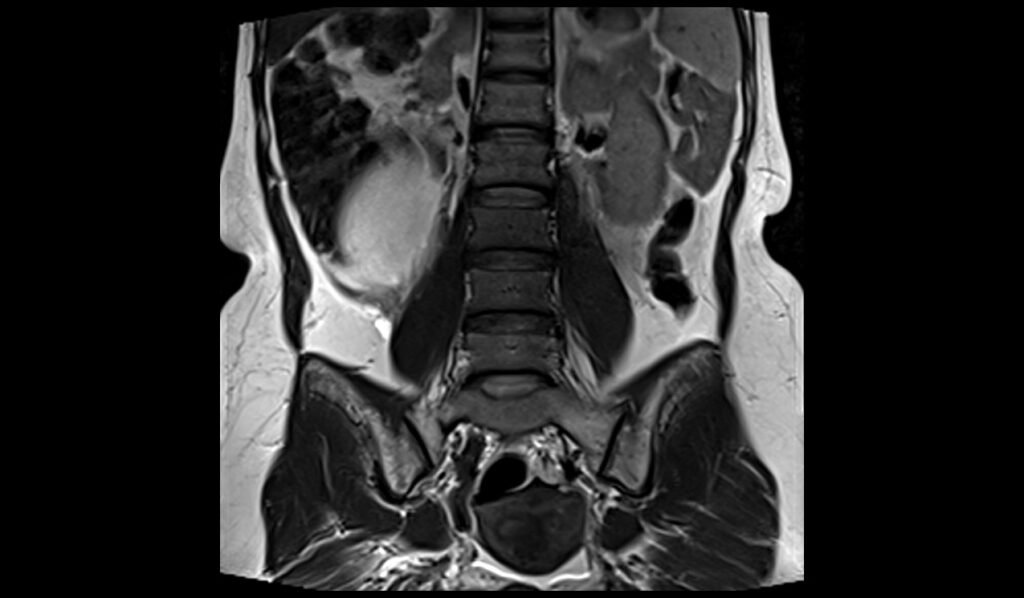 MRI Large Abdomen And Pelvic Masses T2 Coronal Images Mrimaster mri-large-abdomen-and-pelvic-masses-t2-coronal-images-mrimaster