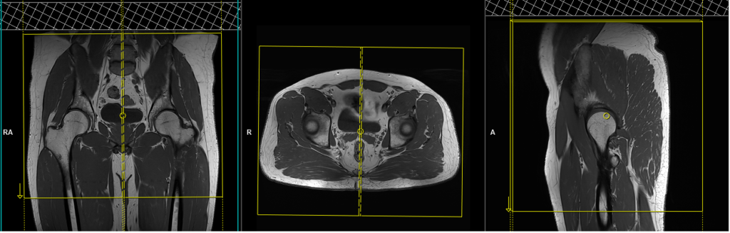 MRI MSK pelvis sagittal planning