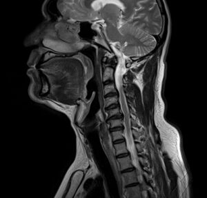 MRI Soft tissue neck sagittal T2 images