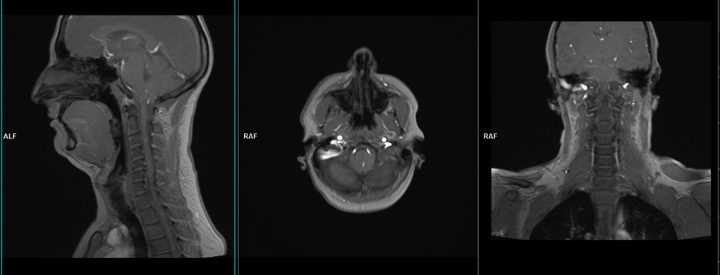 MRI NECK localiser image