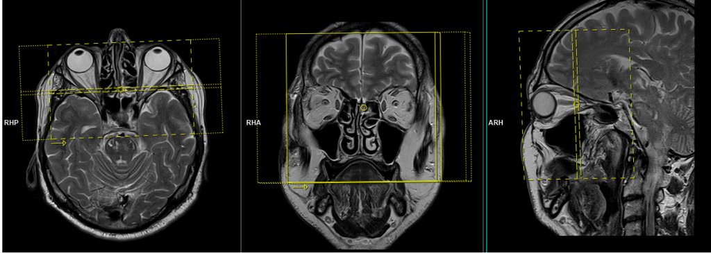 MRI ORBITS PLANNING OF CORONAL