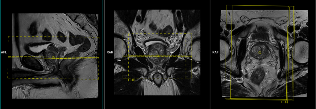 MRI Prostate protocol and planning of axial DWI scans
