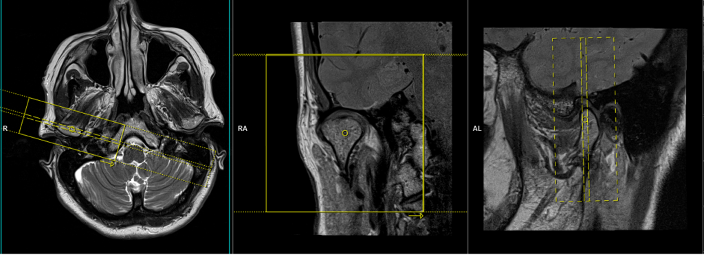 MRI TMJ Planning of coronal right side scans