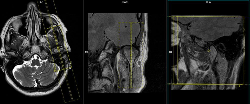 Figure 2 from Survey on Various Techniques of Brain Tumor Detection from MRI  Images | Semantic Scholar