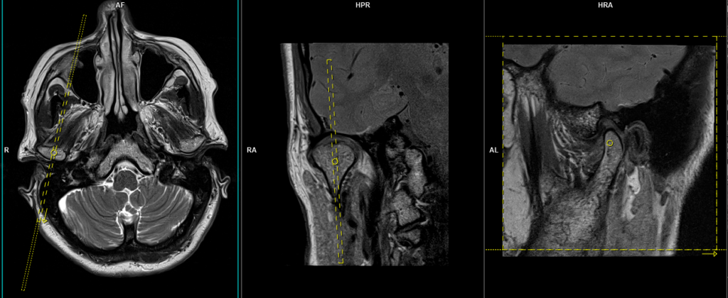 MRI TMJ Planning of sagittal right side dynamic scan