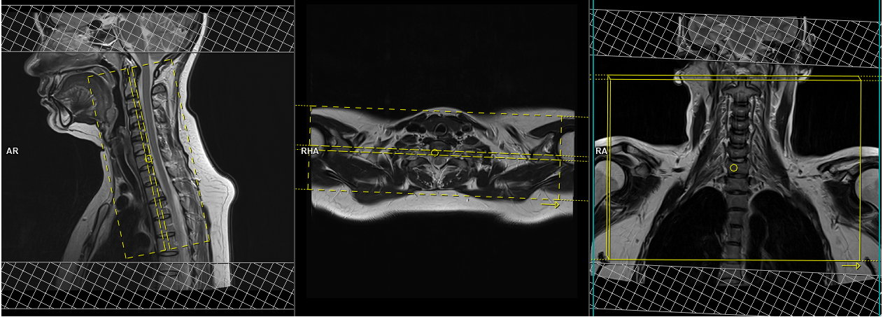 Brachial Plexus MRI Protocols, Planning And Indications