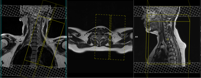 Brachial Plexus MRI Protocols, Planning And Indications