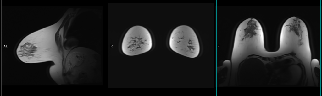 MRI breast localizer image