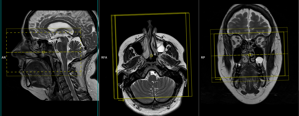 MRI facial nerve | facial nerve MRI protocol and planning