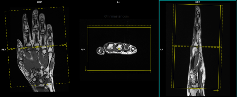 MRA (magnetic resonance angiography) hand protocols and planning ...