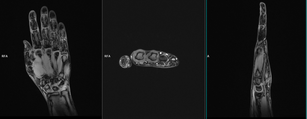 MRI hand localiser planning image