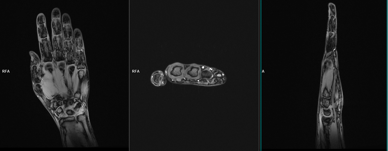 Hand MRI protocols and planning | indications for MRI hand scan