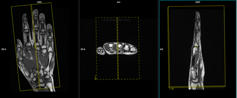 Hand MRI protocols and planning | indications for MRI hand scan