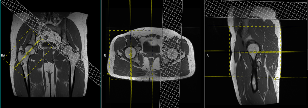 MRI hip planning and protocol of axial oblique scans