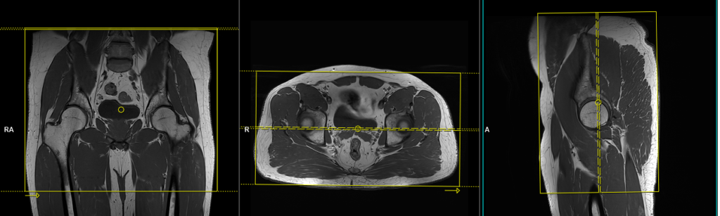 MRI musculoskeletal (MSK) pelvis coronal planning and protocol