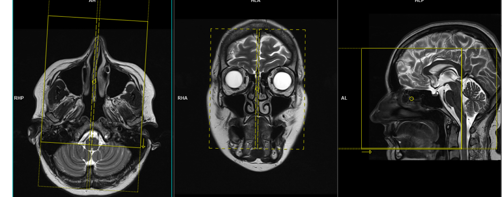 Frontal Plane Mri