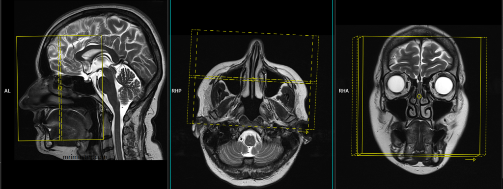 MRI paranasal sinuses planning of coronal scans