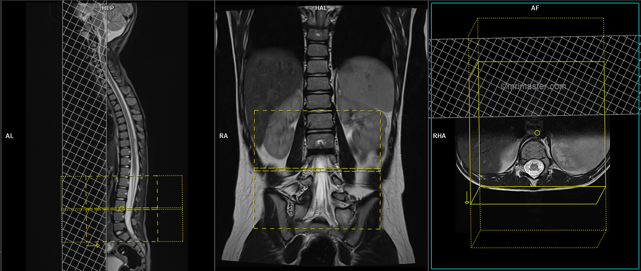 MRI Pediatric Spine | MRI Pediatric Whole Spine Protocol And Planning