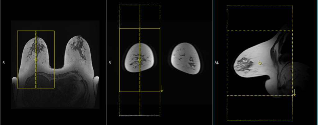 a) Conceptual patient set up under MRI scanner. (b) Average breast size.