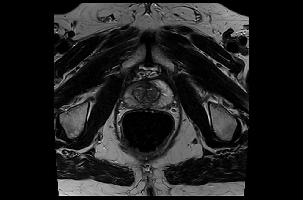 Prostate Axial T2 High Resolution Images Mrimaster 3937