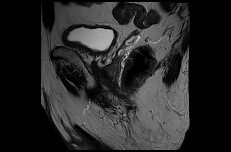 Prostate Mri 3t T2 Sagittal Images Mrimaster