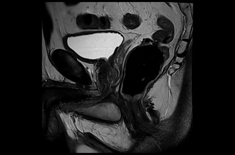 Prostate Mri 3t T2 Sagittal Images Mrimaster