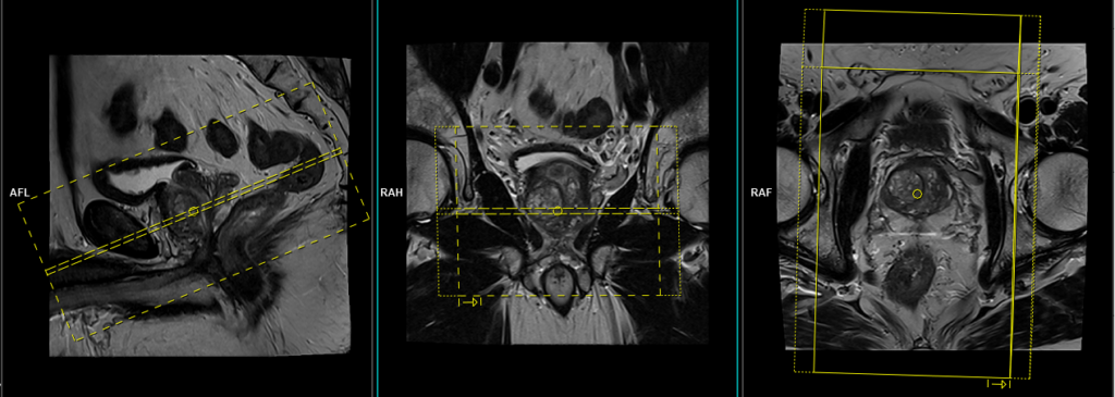 MRI prostate protocol and planning of axial oblique ZOOMIT DWI scans