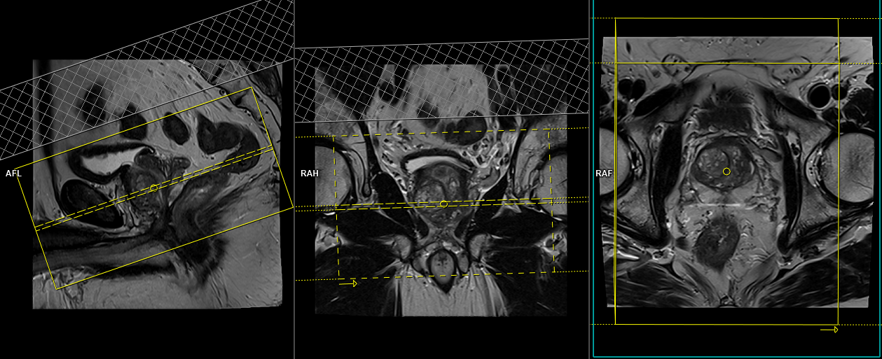 Mri Prostate Protocols Mri Prostate Cancer Multiparametric Planning 9294