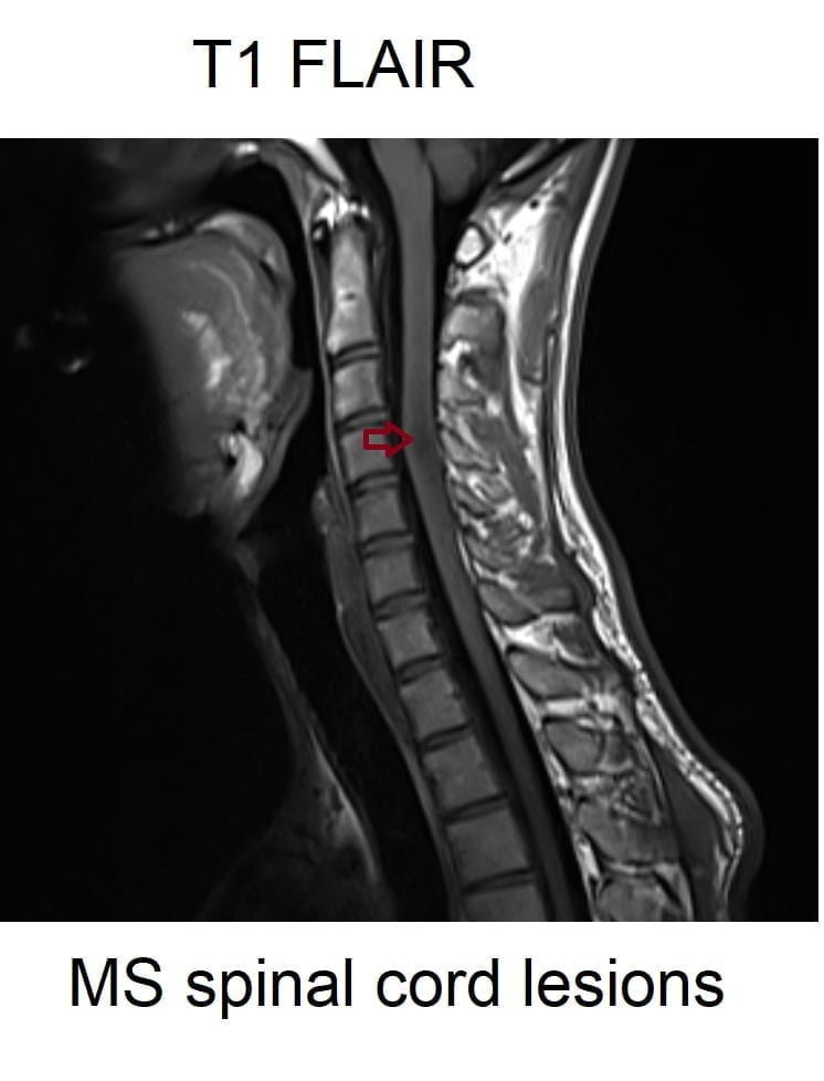 FLAIR MRI FLAIR MRI Sequence Physics Image And Pathology Appearance