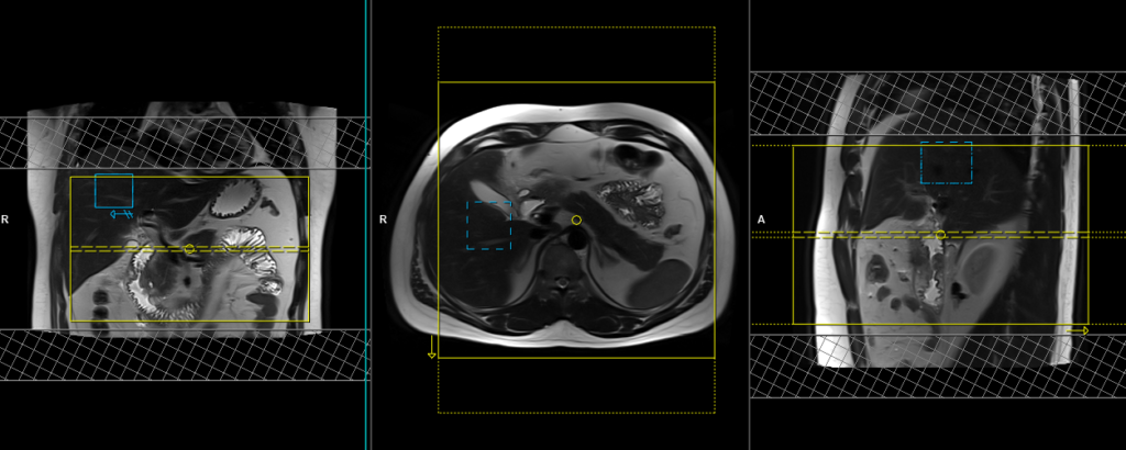 PANCREAS MRI (respiratory gated) axial scan protocol and planning image