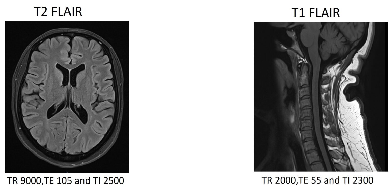 FLAIR MRI FLAIR MRI Sequence Physics, Image and Pathology Appearance